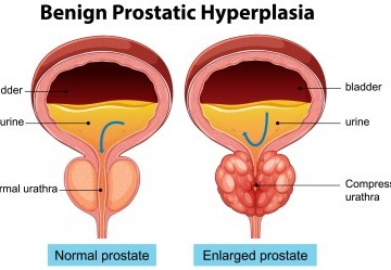 Necessit&agrave; di urinare spesso? Scopri cause e rimedi per la minzione frequente nell'uomo